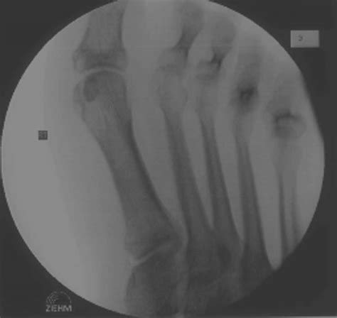 Fibular Sesamoid Agenesis The Foot And Ankle Online Journal