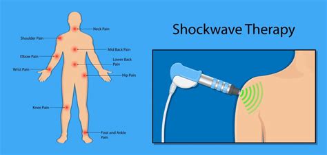 What Is Shockwave Therapy And How Can It Help You Pro Fit Physio