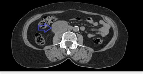 Axial Abdominal Ct Scan Showing A Right Retroperitoneal Mass Blue