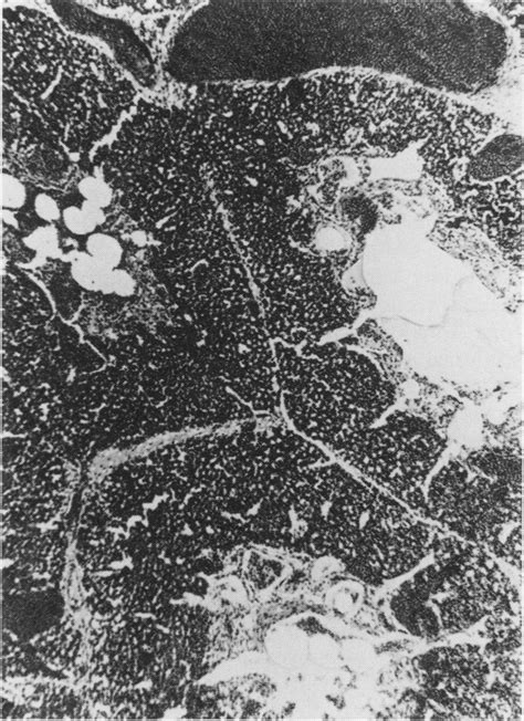 marked pulmonary congestion  scientific diagram