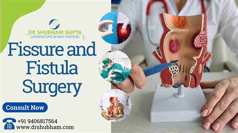 Fissure and Fistula Surgery: Causes, Types, and Treatment