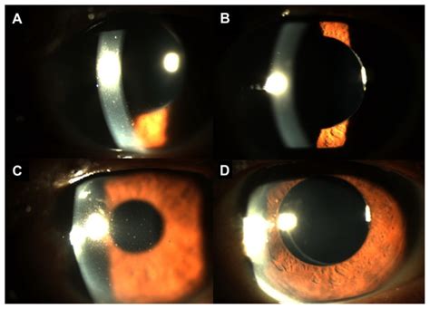 Anterior Uveitis Slit Lamp