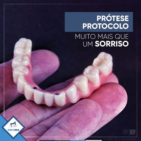 apenas 4 implantes é possível colocar esta prótese fixa e voltar a