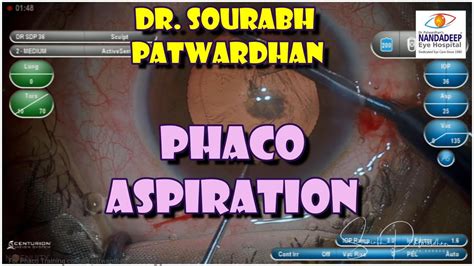 250 Teaching Video Phaco Aspiration The Method Dr Sourabh Patwardhan Youtube