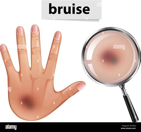 Bruised Skin Stock Vector Images Alamy