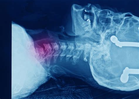 What Is A C6 Spinal Cord Injury Total Community Care