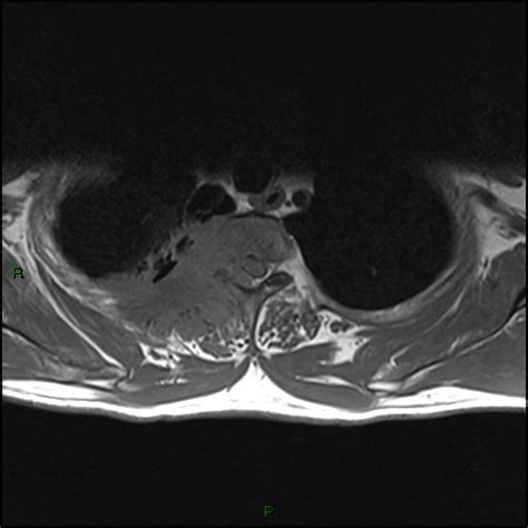 Pancoast Tumor Pacs