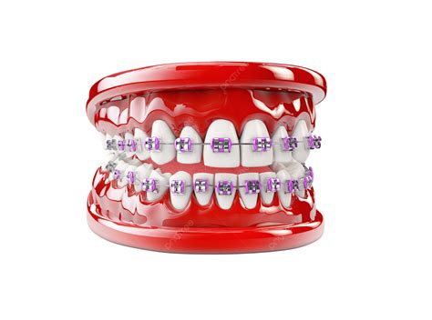 Of Dental Care Concept With Braces Illustration Brace Healthy Png