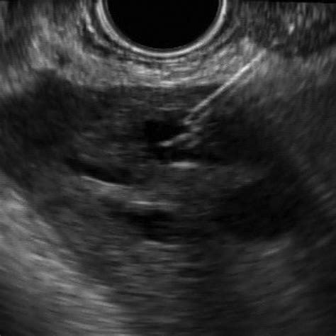 Ct Image Of The Viabil Stent Across The Hepaticogastrostomy Download