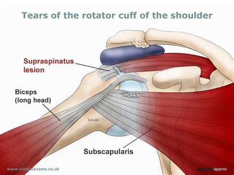 Diagram Diagram Of Rotator Cuff Tear Wiringschema