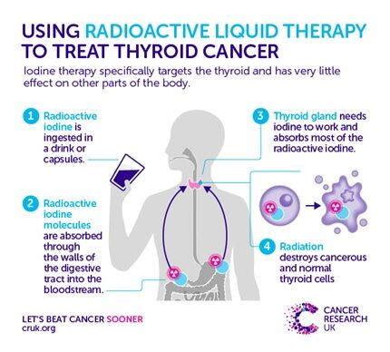 Thyroid Cancer Types Symptoms Diagnosis Treatment PMCC Denver