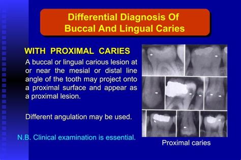 Radiographic Assessment Of Dental Caries Ppt