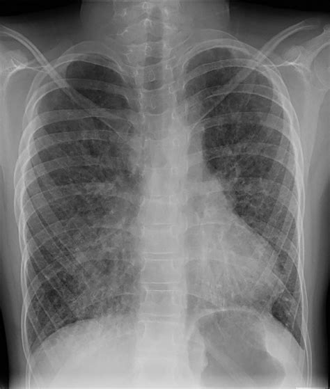 Surfactant Protein C Deficiency Associated Diffuse Lung Disease