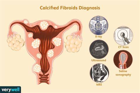 Calcified Fibroids: Symptoms, Treatment, and Removal