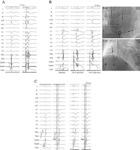 A 12 Lead Ecg With Intracardiac Electrograms Showing Nearfield His