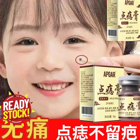 concentrated potent skin tag removal apgar mole cream