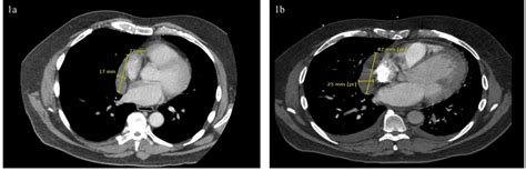 A Rare Complication Of A Rare Disease Pericarditis Due To Ruptured