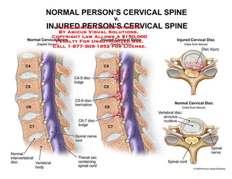 normal persons cervical spine  injured persons spine