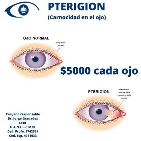 Cirugia de Carnosidad en el Ojo Clínica Oftalmologia Obispado Monterrey