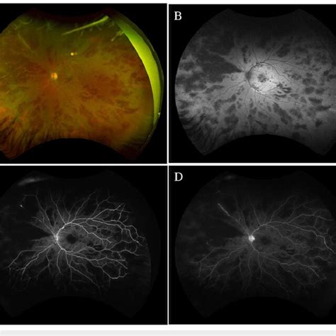 Ultrawide Field Retinal Imaging Of The Left Eye Days After