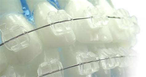 Ортодонтия и Брекети Пловдив: Индиректен Бондинг