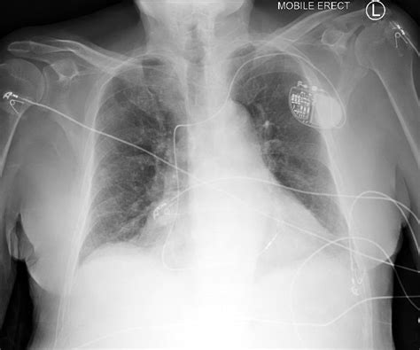 pulmonary edema  ray image chest  ray aeroh