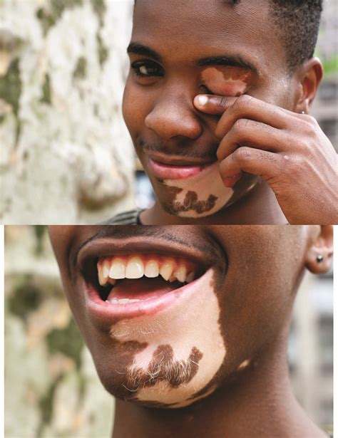 The Skin Disorder Vitiligo Is Changing Jasmine Colgan, And Those She