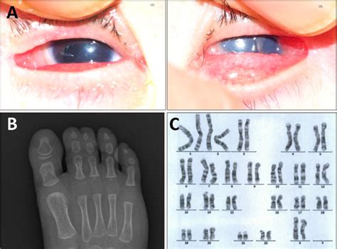 Figure From Hypomelanosis Of Ito With Multiple Congenital Anomalies