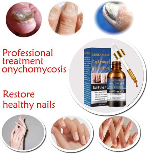 The Ultimate Guide To 6 Best Home Remedies For Toenail Fungus Telegraph