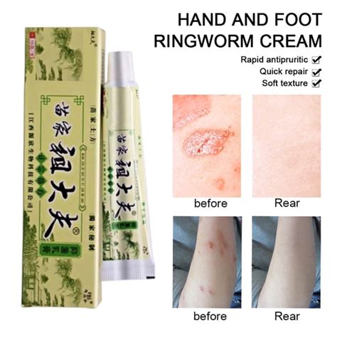 G Zudaifu Chinese Herbal Skin Psoriasis Cream Dermatitis Eczematoid