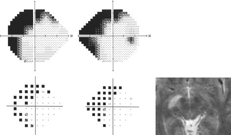 Congruency In Homonymous Hemianopia American Journal Of Ophthalmology