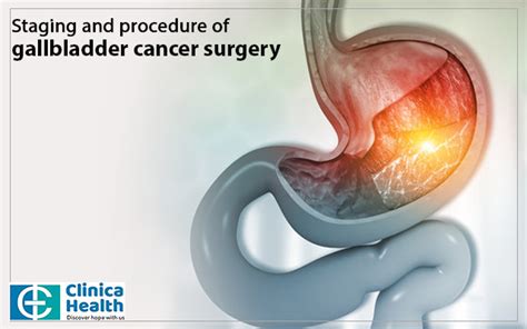 Staging And Procedure Of Gallbladder Cancer Surgery Clinicahealth