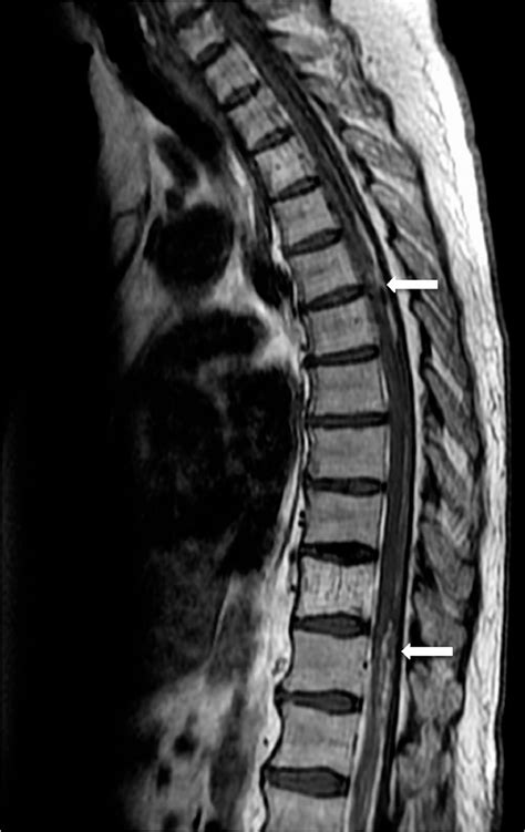 Spontaneous Spinal Subarachnoid Hemorrhage Presentation And Outcome