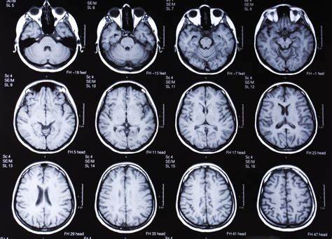 Anatomía De La Tomografía Computarizada Del Cerebro
