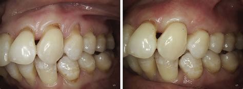 Gum And Soft Tissue Grafting In Edison Nj Lakewood Nj Gum And Soft