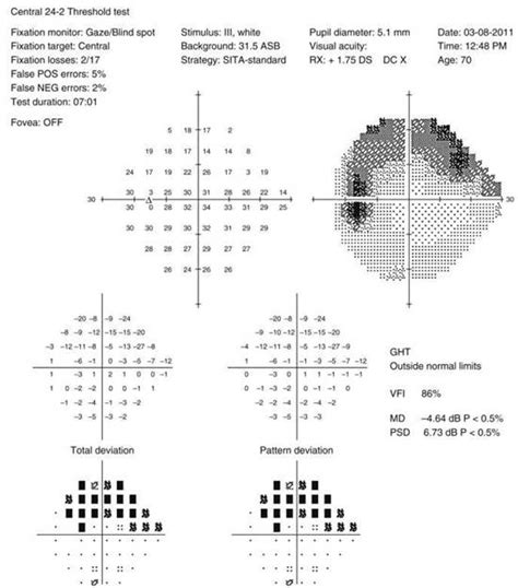 Manual Visual Field Test