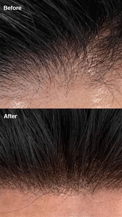 Scalp Micropigmentation Specialised Technicians Liverpool Sydney