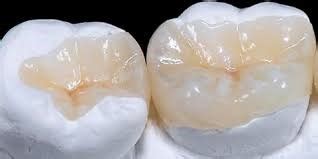 İnley ve Onley Dolgu Nedir? - İnley Onley Dolgu Fiyatları Ne Kadar?