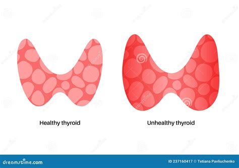 Thyroid Gland Disease Stock Vector Illustration Of Healthy