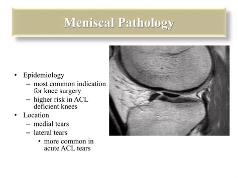Meniscal injury | PPTX