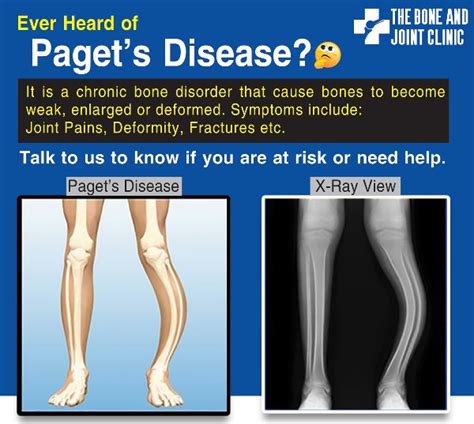 How Rare Is Paget S Disease At Chelsie Malika Blog