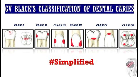 Gv Blacks Classification Of Dental Caries Youtube