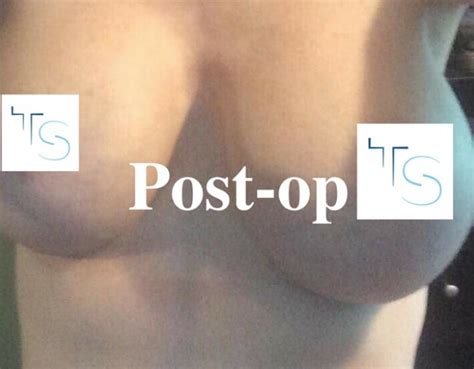 Boob Job Goes Wrong A Mum Of Four S Horror Story