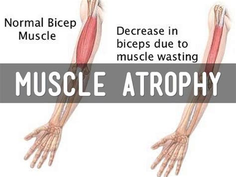 Defying Muscle Atrophy: Build an Ark of Strength with Strength Training ...