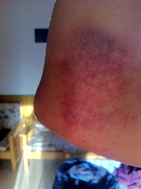 Bruised Elbow Flickr Photo Sharing