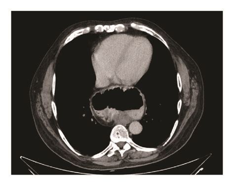 CT scan showing huge hiatal hernia and upside-down stomach. | Download