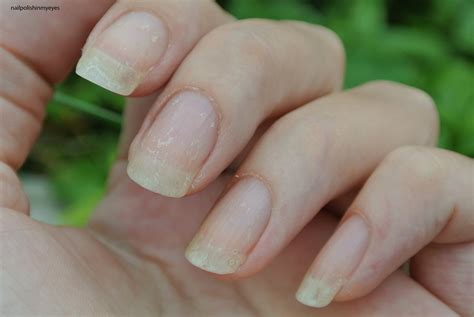 How eczema affected my nails… | Nail Polish in my Eyes
