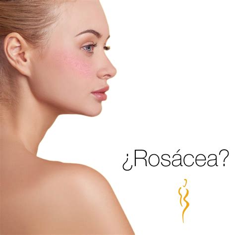 Rosácea Nubia Cárdenas Medicina Estética