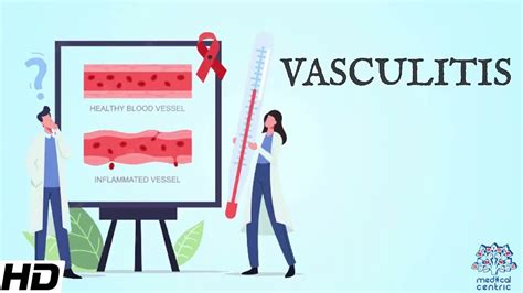 Vasculitis Everything You Need To Know YouTube