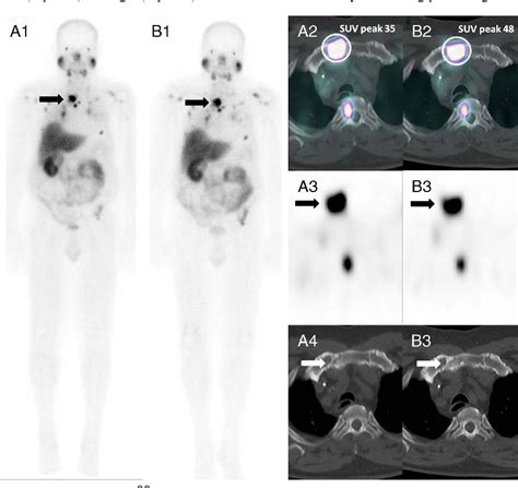 Figure From Tc Mip Spect Ct For Patients With Metastatic